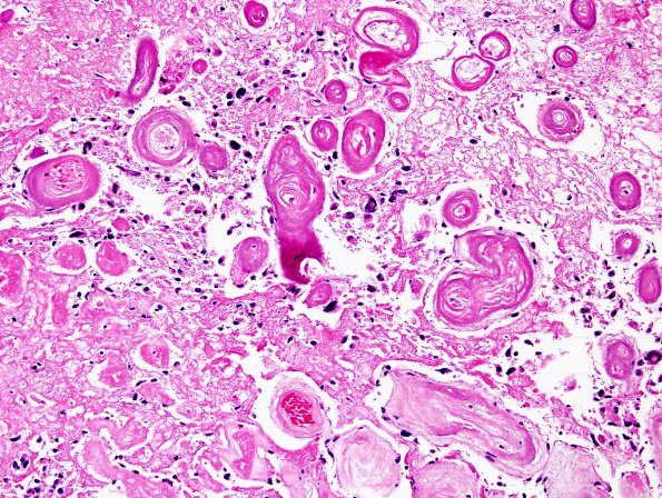 11B3 GBM with Radiation Necrosis (Case 11B) H&E 3