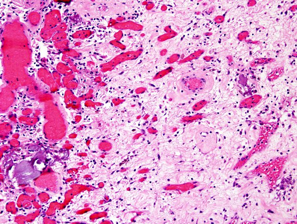 11B4 GBM with Radiation Necrosis (Case 11B) H&E 2