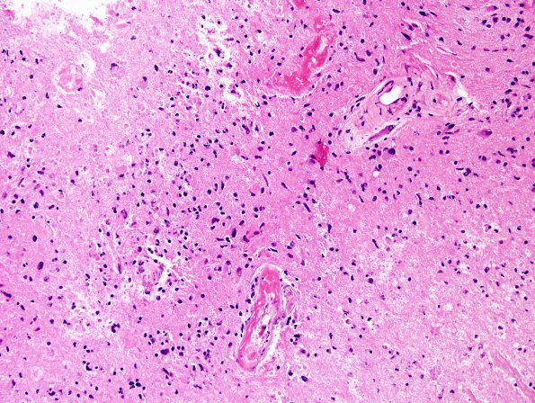 11B5 GBM with Radiation Necrosis (Case 11B) H&E 8