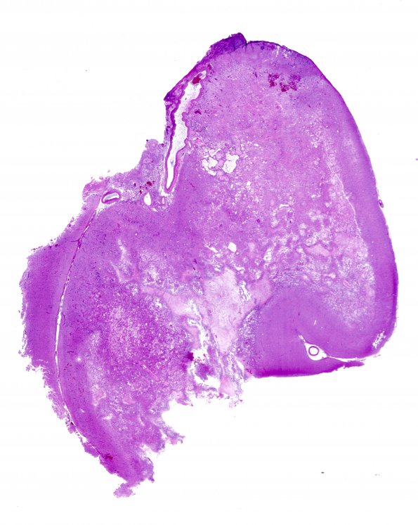 11C1 GBM, Radiation (Case 11C) H&E WM