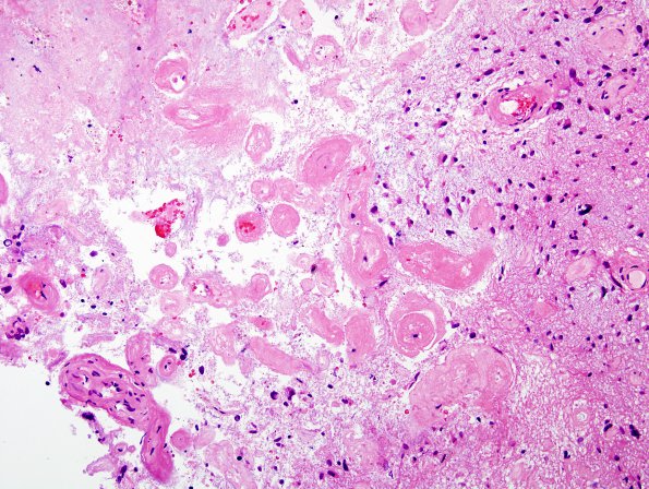 11C2 GBM, Radiation (Case 11C) H&E 2