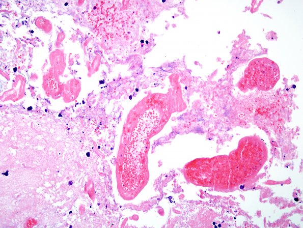 11C3 GBM, Radiation (Case 11C) H&E 5