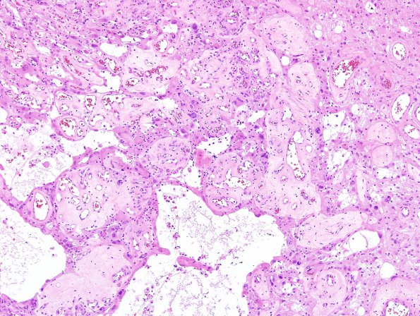 11C4 GBM, Radiation (Case 11C) H&E 22