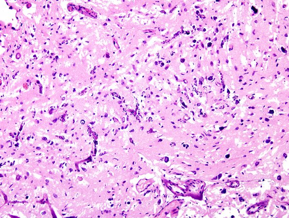 11C5 GBM, Radiation (Case 11C) H&E 19