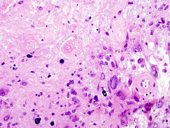 11C6 GBM, Radiation (Case 11C) H&E 11