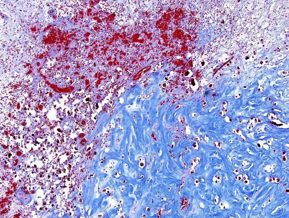 11D2  GBM sp RadioRx (Case 11D) Trichrome 2