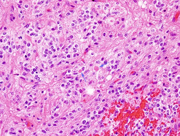 12A1 GBM (with spheroids) (Case 12) H&E 2 copy