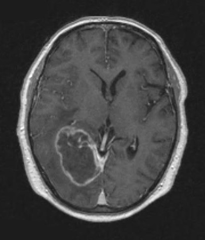 1A2 GBM (Case 1A) T1 W 2 - Copy