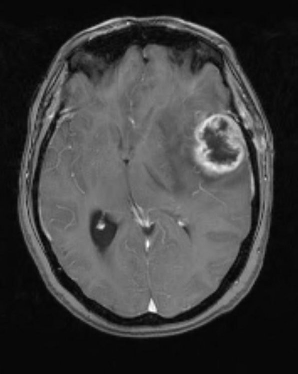 1B2 GBM (Case 1B) T1 W - Copy