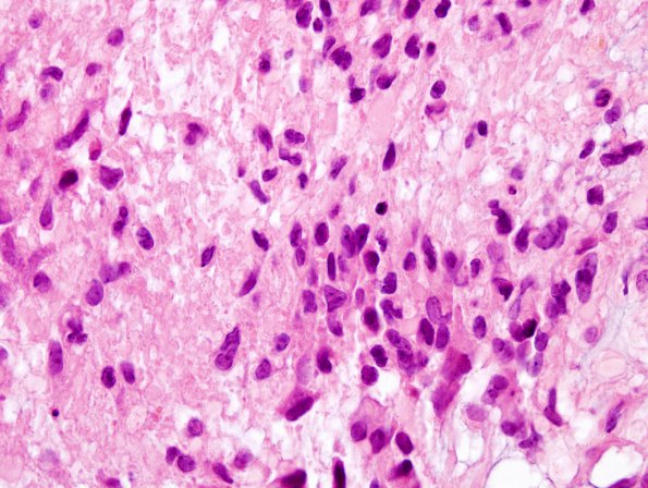 2A3 GBM (Case 2A3) bipolar nuclei H&E