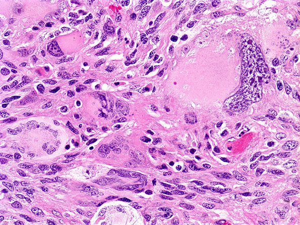 2B5 Glioblastoma (Case 2B5) H&E 1