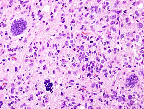 2B6 Glioblastoma (Case 2B6) H&E 10