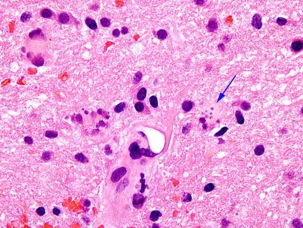 2C2 GBM, Creutzfeldt cells (Case 2C2) H&E 7A.jpg