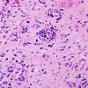 3A7 Glioblastoma (Case 3A7) H&E 1