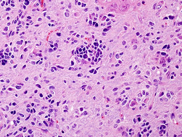 3A7 Glioblastoma (Case 3A7) H&E 1