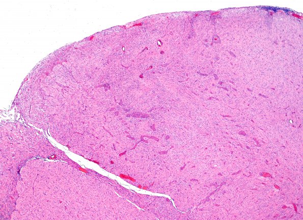 3C1 GBM (Case 3C) leptomeningeal invasion H&E 1.jpg