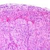 3C2 GBM (Case 3C) leptomeningeal invasion H&E 2.jpg