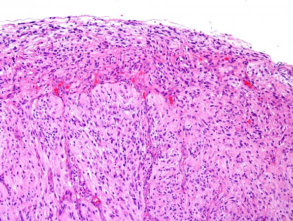 3C2 GBM (Case 3C) leptomeningeal invasion H&E 2.jpg