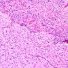 3C3 GBM (Case 3C) leptomeningeal invasion H&E 6.jpg