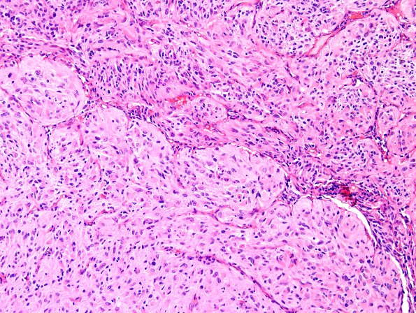 3C3 GBM (Case 3C) leptomeningeal invasion H&E 6.jpg