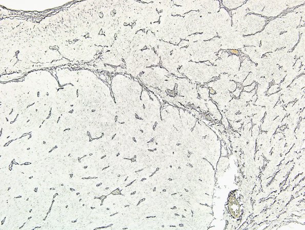 3C4 GBM (Case 3C) leptomeningeal invasion Retic 4.jpg