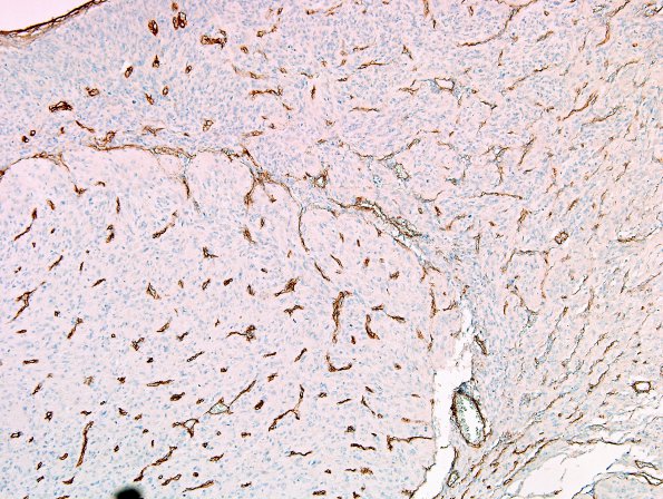 3C5 GBM (Case 3C) leptomeningeal invasion Coll IV 3.jpg