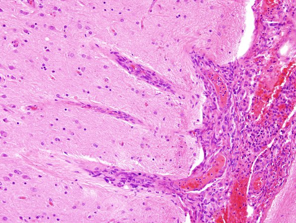 3D1 GBM with dural and skull reaction (Case 3D) H&E 6.jpg