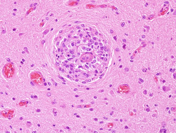 3D2 GBM with dural and skull reaction (Case 3D) H&E 9.jpg