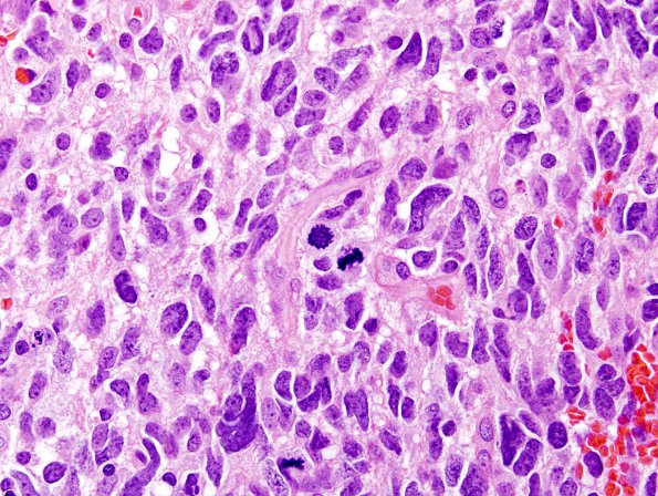 4A2 Glioblastoma (Case 4A) H&E 8