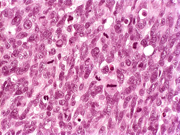 4A3 Glioblastoma (Case 4A) 2