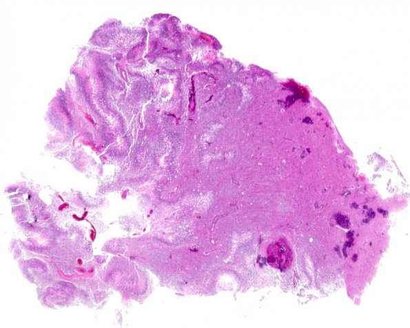 5A1 Glioblastoma (Case 5A1) H&E 1