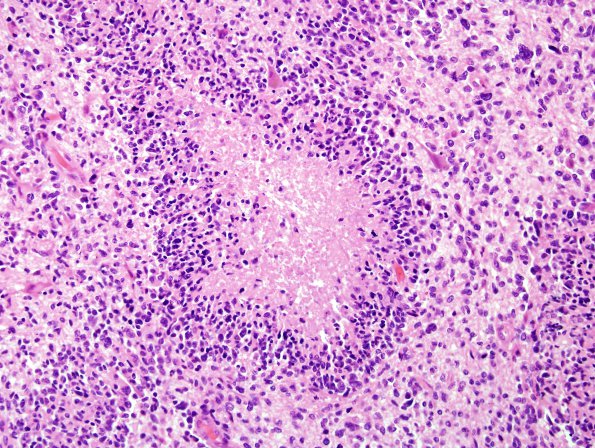 5A5 GBM (Case 5A3) H&E cortex nodule area 2