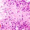 5B1 GBM (Case 5B1) bipolar nuclei