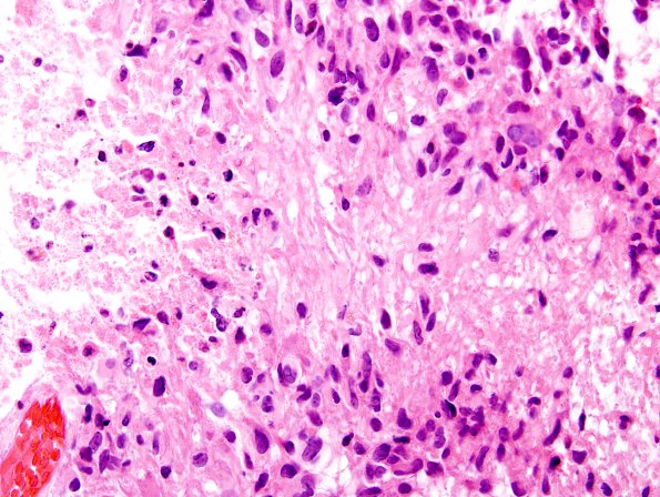 5B1 GBM (Case 5B1) bipolar nuclei