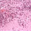 5B3 Glioblastoma (Case 5B3) 1