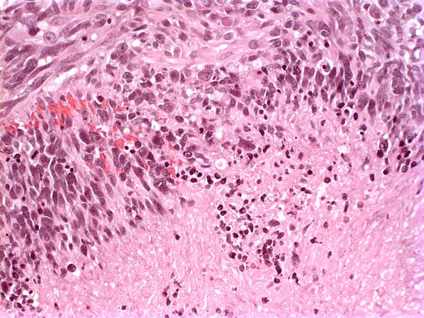 5B3 Glioblastoma (Case 5B3) 1