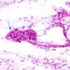 6A1 GBM, endothelial proliferation, smear (Case 6A1) H&E 1 copy