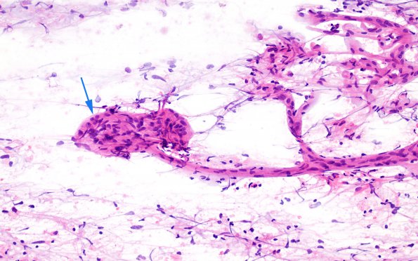 6A1 GBM, endothelial proliferation, smear (Case 6A1) H&E 1 copy