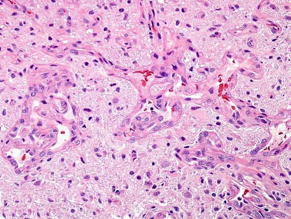 6A4 GBM (Case 6A4), endoth prolif H&E 1