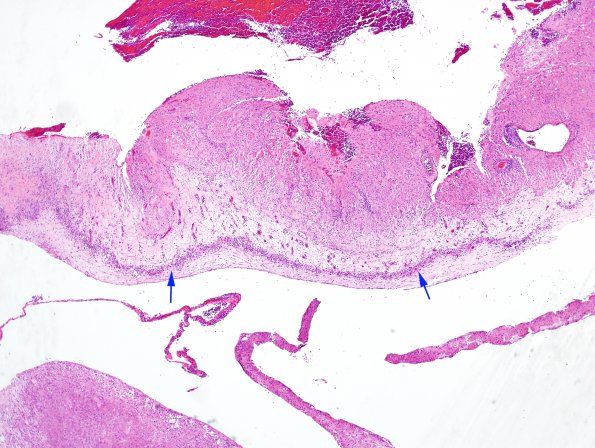 6B1 GBM (Case 6B1) H&E 1A