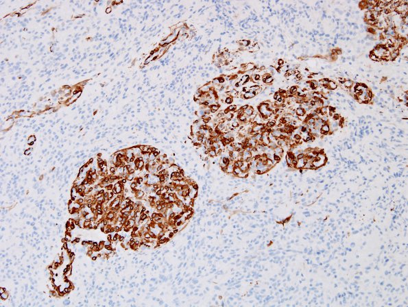 6C2 GBM (Case 6B6) SMA 1.jpg