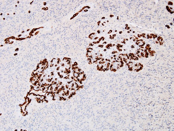 6C3 GBM (Case 6B6) CD34 1.jpg