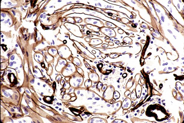 6E Glioblastoma (Case 6E) Coll IV