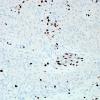 6F GBM, endothelial proliferation (Case 6F) Ki67 1.jpg