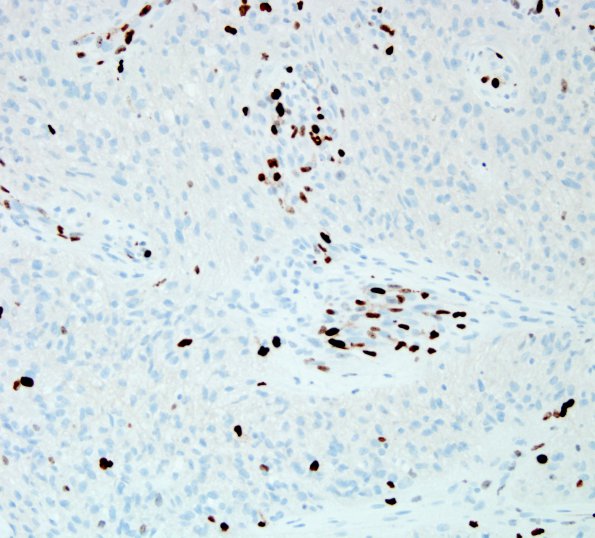 6F GBM, endothelial proliferation (Case 6F) Ki67 1.jpg