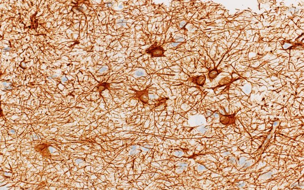 8A4 GBM (Case 8A4) GFAP reactive 2