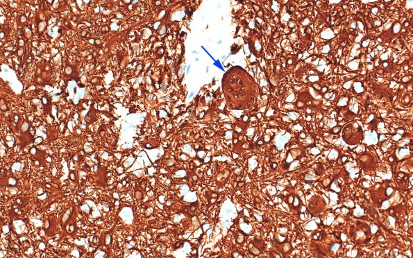 8D3 GBM Creutzfeldt cells (Case 8D1) GFAP 4A