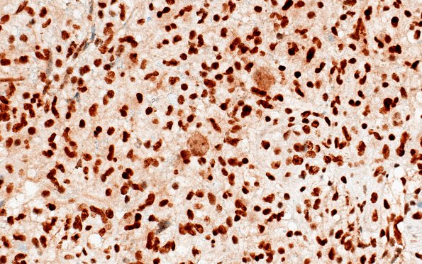 8D4 GBM Creutzfeldt cells (Case 8D1) ATRX 2