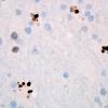 8D5 GBM, Creutzfeldt cells (Case 8D5) p53 1.jpg