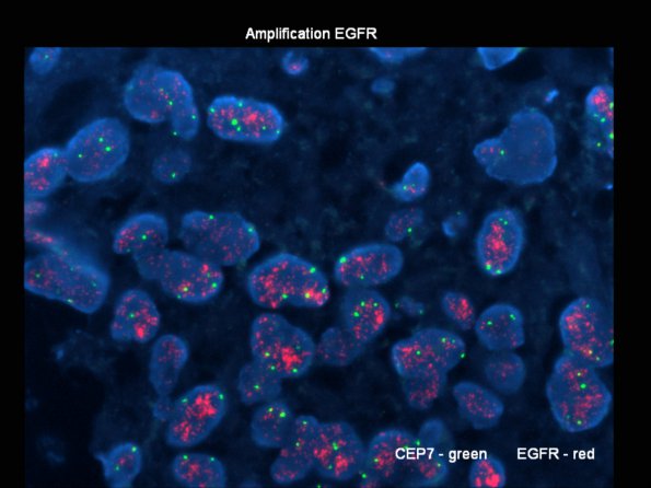 9B1 GBM (Case 9B1) EGFR - Copy